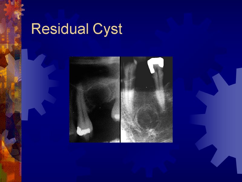 Residual Cyst